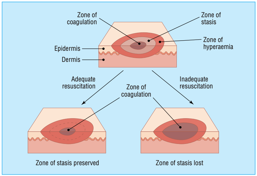 Jackson's Burn Wound Model